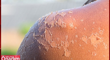 Hassas Ciltler Koruyucu Sürmeden Çıkmamalı Kansere Kadar Götürüyor!