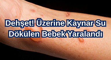 Dehşet! Üzerine Kaynar Su Dökülen Bebek Yaralandı